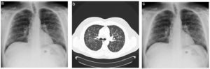 (A) Chest radiography showed a bilateral micronodular interstitial pattern. (B) CT showed a micronodular lung pattern with cavitation consistent with the Cheerio sign (blue arrowheads). (C) Chest radiography showed improvement at 6 months after smoking cessation.