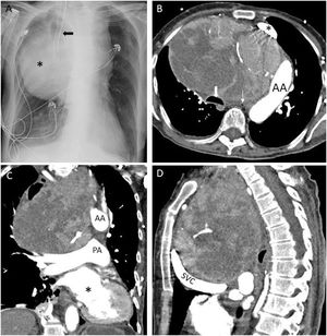 (A) Portable chest radiograph showing mass-like widening of the mediastinum (asterisk). The path of the endotracheal tube demonstrates the rightward deviation of the trachea (arrow). (B) Axial section from chest computed tomography (CT) performed after administration of intravenous contrast and set to soft tissue window showing a giant, heterogeneous anterior mediastinal mass displacing the aortic arch (AA) laterally and the innominate vein (asterisk) anteriorly while compressing the trachea (thick arrow) and esophagus (thin arrow), both of which are markedly displaced from their normal locations. (C) Coronal reconstruction from the CT depicted in panel B highlighting the mass effect on the heart (asterisk), which is displaced inferolaterally, and on the pulmonary artery (PA), which is forced into a near-horizontal orientation by the mass. AA denotes the aortic arch cut in cross-section. (D) Saggital reconstruction from the same CT highlights the dramatically abnormal path of the superior vena cava (SVC), which wraps around the underside of the mass in a near-horizontal orientation.