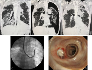 (A) Coronal reconstruction of chest computed tomography (CT) reveals traction bronchiectasis accompanied by a linear reticular shadow predominantly in the subpleural upper lobes, with surrounding pleural effusion. Additionally, ground-glass opacities (GGO) and a reversed halo-like shadow are predominantly observed in the right lower lobe, indicative of pleuroparenchymal fibroelastosis exacerbation. (B) After the administration of corticosteroids and pirfenidone, coronal reconstruction of chest CT reveals improvement of GGO and a reversed halo-like shadow. However, severe pneumothorax is observed in the left lung. (C) Fluoroscopic radiograph showing a left pneumothorax with a chest tube inserted into the left thoracic cavity. Additionally, endobronchial Watanabe spigots (EWS) are implanted at left B1+2 using a flexible bronchoscope. (D) The bronchoscopic findings reveal redness of the bronchial mucosa caused by the insertion of an EWS in the left B1+2b. (E) Coronal reconstruction of chest CT after EWS insertion demonstrates improvement of the inserted EWS, left pneumothorax, and right dominant GGO and reversed halo-like shadow. Abbreviations: CT, computed tomography; GGO, ground-glass opacities; EWS, endobronchial Watanabe spigot; PPFE, pleuroparenchymal fibroelastosis.