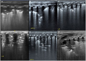 Ultrasound findings of different types of pneumonia caused by different pathogens. This figure shows that pneumonia caused by various pathogens that mainly manifests as lung consolidation with air bronchograms and irregular boundaries on ultrasound images (arrow) (A: Mycoplasma pneumoniae). B: Candida albicans-related pneumonia. C: Respiratory syncytial virus pneumonia. D: Klebsiella pneumoniae pneumonia. E: Legionella pneumonia. F: E. coli pneumonia).