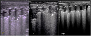 Comparison of the ultrasound features among patients with congenital pneumonia, nosocomial pneumonia and community-acquired pneumonia. As shown in this figure, the ultrasound manifestations of congenital pneumonia (A), nosocomial pneumonia (B) and community-acquired pneumonia (C) were similar. The main manifestations were significant lung consolidation involving multiple intercostal spaces with or without air bronchograms and regular boundaries (arrow).