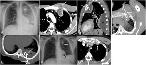 (A) Chest radiograph (posteroanterior view) shows an ill-defined lesion projected over the sternochondral joint of the first left rib (asterisk). Note the increased density of the left hemithorax due to an ipsilateral pleural effusion. (B) Axial thoracic CT image (mediastinal window) shows an extrapleural fluid collection (asterisk) and demonstrates a small low-attenuation lesion in the left pectoralis major muscle (arrow). (C) Sagittal thoracic CT image (mediastinal window) better shows the extrapleural fluid collection (white asterisk) originating in the first sternochondral joint (arrow) and a large loculated pleural effusion (black asterisk). (D) Axial thoracic maximum intensity projection (MIP) CT image shows a pigtail catheter (arrows) within the extrapleural fluid collection (asterisk). (E) Axial thoracic MIP image shows another pigtail catheter (arrows) within the left pleural effusion. (F) Chest radiograph (posteroanterior view) obtained 1 week after the insertion of the pigtail catheters (arrows) shows marked improvement. Note the reduction in size of the extrapleural lesion in the left upper hemithorax (asterisk). (G) Axial thoracic CT image (mediastinal window) performed 8 weeks after the insertion of the pigtail catheter shows complete resolution of the extrapleural collection and minimal residual thickening of the soft tissues surrounding the first sternochondral joint (arrow).
