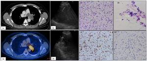 (1a) Contrast-enhanced CT reveals a mild enhanced mass in the left pulmonary artery. (1b) 18F-fluorodeoxyglucose (FDG) positron emission tomography with integrated CT shows a positive uptake of FDG to the pulmonary artery mass. (2) Ultrasound image of fine needle (2a) and cryoprobe (2b) in the middle of the mass. (3) Hemtoxylin–eosin: atypical spindle cells with irregular, pleomorphic, large spindle-shaped nuclei, with elongated cytoplasms (3a,3b). Immunocytochemical study: MDM2++ positive tumor cells (3c) and negative for actine (3d).