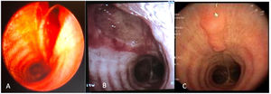 (A) 3cm longitudinal laceration of the tracheal posterior wall, up to the submucosa; (B) bronchofibroscopy at 4 days; signs of healing; (C) bronchofibroscopy at 1 month; signs of granulation tissue.