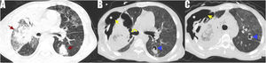 Computed tomography of the immunocompromised patient showed diffuse ground-glass densities in both lungs. Red arrows show ground-glass densities, consolidated areas (A). Yellow arrows show pleural rupture. White asterisks indicate the area of subcutaneous emphysema, yellow curved arrow indicate bronchopleural fistula, blue arrowheads indicate different aspergillomas showing the air crescent (B and C).