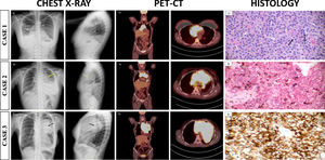 (a) Posteroanterior and lateral chest radiograph a mass in the anterior mediastinum (white arrow) with middle lobe atelectasis and elevation of the right hemidiaphragm. (b) Positron emission tomography-computed tomography (PET-CT) with an anterior mediastinal mass (9cm×8cm×12cm) with higher maximum standardized uptake values (SUVmax) of 24, with invasion of the phrenic nerve. (c) Large cells with centroblastic appearance and pleomorphism in an inflammatory background and fibrotic stroma with resembling Reed-Sternberg cells (black arrow) (hematoxylin–eosin, original magnification 400×). (d) Posteroanterior and lateral chest radiograph with an anterior mediastinal mass (yellow arrow) and left pleural effusion. (e) PET-CT with a 14cm×13cm×15cm mass in the anterior mediastinum with a SUVmax of 19 with compression of the superior vena cava and adenopathies. (f) Immunohistochemical stainin with neoplastic cells with expression of CD20 (original magnification 400×). (g) Posteroanterior and lateral chest radiograph with anterior mediastinal mass (black arrow) with left pleural effusion. (f) PET-TC with a 13cm×14cm×17cm mass in the anterior mediastinum with a SUVmax of 19.6 and compression of the superior vena cava. (i) Malignant cells with strongly expression of CD30 (original magnification 400×).