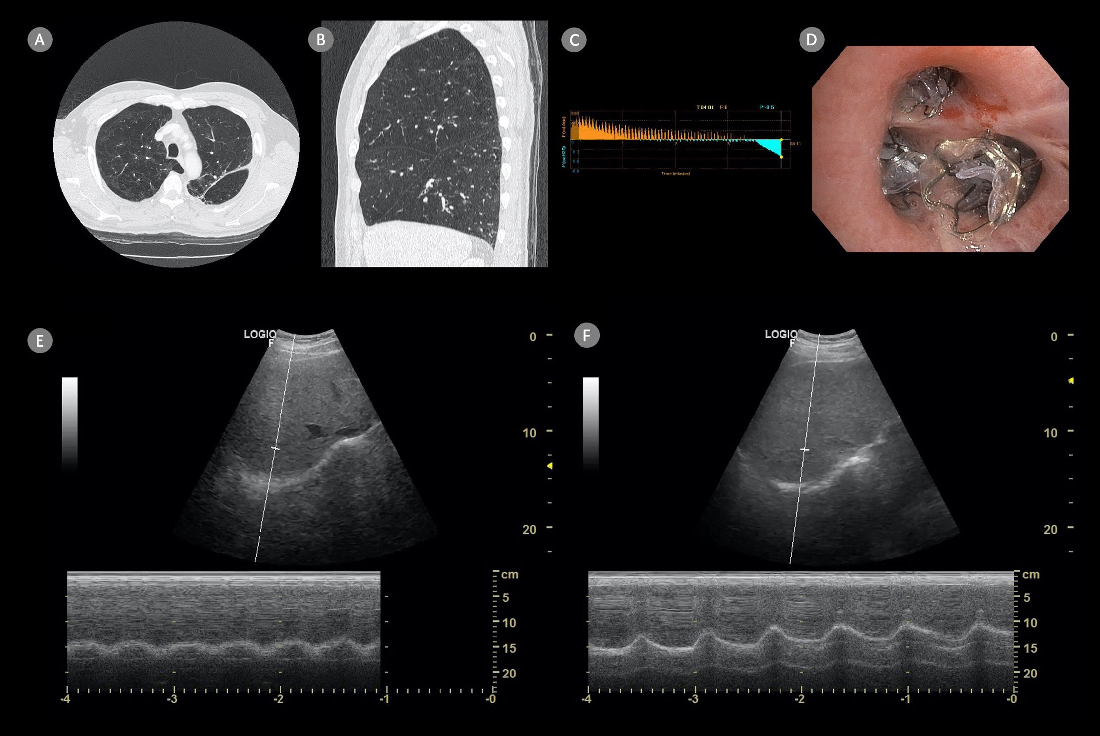 The Effect of Bronchoscopic Lung Volume Reduction on Hemidiaphragm ...