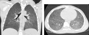 HRCT showing bilateral diffuse centro-lobular ground glass opacities.