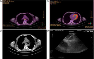 (a) Subcarinal lymphadenopathy on PET/CT; (b) pulmonary nodule on PET/CT; (c) subcarinal lymphadenopathy on CT; (d) cryoEBUS in real-time. (a) Subcarinal lymphadenopathy on PET/CT; (b) pulmonary nodule on PET/CT; (c) subcarinal lymphadenopathy on CT; (d) cryoEBUS in real-time.