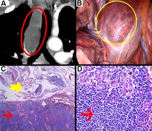(A) Thoracic coronal CT scan with intravenous contrast show a hypodense mediastinal cyst (red circle) with 9HU. (B) Mediastinal cyst surrounded by the superior vena cava and the right phrenic nerve (yellow circle). (C) Microscopic image ×40, lymphatic follicles (thin red arrow) and vascular structures (thick yellow arrow). (D) Image ×80, lymphatic follicles (thin red arrow). (A) Thoracic coronal CT scan with intravenous contrast show a hypodense mediastinal cyst (red circle) with 9HU. (B) Mediastinal cyst surrounded by the superior vena cava and the right phrenic nerve (yellow circle). (C) Microscopic image ×40, lymphatic follicles (thin red arrow) and vascular structures (thick yellow arrow). (D) Image ×80, lymphatic follicles (thin red arrow).