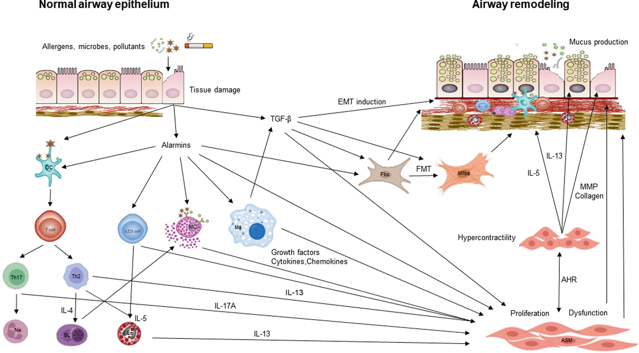 Airway Remodeling in Asthma: Mechanisms, Diagnosis, Treatment, and ...