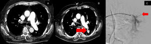 A – demonstrates a CT image pre-thrombectomy without a pulmonary pseudoaneurysm. B – displays a CT image revealing a new heterogeneously hyperdense structure in the superior left lower lobe measuring up to 1.9cm×2.9cm, which appears to demonstrate connection to a left lower lobe segmental pulmonary artery concerning for a pulmonary pseudoaneurysm. C – pulmonary angiography with embolization of superior left lower lobe segmental pulmonary artery with coil.