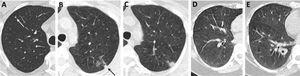 (A–E) Assessment of risk of LC in the next 1–6 years based on the analysis of baseline LDCT with the Sybil deep learning algorithm.90 (A) Prediction of a very low probability of LC after 1 year (risk score=0.0109) and 6 years (risk score=0.0831) since baseline LDCT in a 59-year-old man from NLST with a small infra-threshold (1.8mm in mean diameter) solid benign nodule in the right upper lobe (white arrow) at baseline LDCT who was alive 11 years after randomization. (B and C) Prediction of a moderate probability of LC after 1 year (risk score=0.3057) and 6 years (risk score=0.5998) since baseline LDCT in a 56-year-old woman from NLST with a small infra-threshold (3.8mm in mean diameter) (black arrow) solid nodule in the left upper lobe at baseline LDCT (B) which showed growth (9mm in mean diameter) at the annual LDCT performed two years later (C) consistent with a pseudo-incidental LC and who received a diagnosis of stage IA adenocarcinoma and was alive 11 years after randomization. (D and E) Prediction of a very low risk of LC after 1 (risk score=0.0017) and 6 years (risk score=0.0329) since baseline LDCT in a 57-year-old woman from NLST with a negative baseline LDCT (D) who showed a large (18mm in mean diameter) solid lesion (*) at the next annual LDCT (E) consistent with an incident LC who received a diagnosis of small cell carcinoma and died of LC (ICD code C349) 1559 days after randomization.