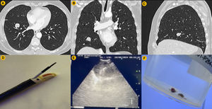 Radiological features of the peripheral pulmonary nodule and procedural setting. (A) Axial axis CT scan. (B) Coronal axis CT scan. (C) Sagital axis CT scan. (D) Linear EBUS showing cryoprobe protected by catheter. (E) Ultrasound image of the cryoprobe inside peripheral pulmonary nodule. (F). Cryobiopsy samples.