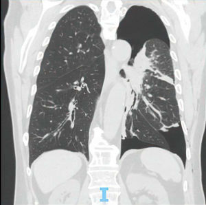 Left hydropneumothorax evidenced by chest CT scan at the time of admission.