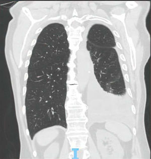 Left pleural effusion with features of free pleural fluid, evidenced on a follow-up chest CT during hospitalization scan after the introduction of psychiatric medication, namely venlafaxine.