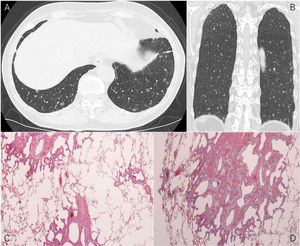 Chest computed tomography (A: axial, B: coronal) showed multiple GGOs predominantly in the bilateral lower lobes with obscured margins, and histopathology (C: low, D: high magnification) revealed thickened alveolar walls with proliferating tumor cells.