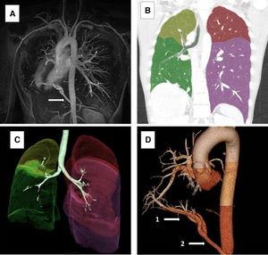 Multimodal imaging findings. (A) Cardiac MRI showing dextrocardia and an anomalous systemic arterial supply to the right lower lobe (arrow). (B) Coronal computed tomography image of the chest with automated pulmonary lobe segmentation, highlighting the agenesis of the right upper lobe, with the right middle and lower lobes displayed in yellow and green, respectively. The left upper and lower lobes are fully visualized and color-coded in red and purple. (C) 3D reconstruction of the tracheobronchial tree revealing the absence of the right upper lobe bronchus. Both (B) and (C) were obtained using Synapse 3D® (Fujifilm). (D) 3D vascular reconstruction from the thoracic CT scan detailing the anomalous systemic arterial supply to the right lower lobe (1), originating from the hepatic artery (2).