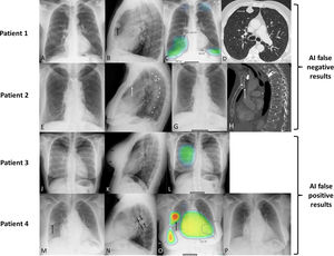 Examples in which the lack of assessment of the lateral projection (LP) by an artificial intelligence-based chest radiograph (AIBCR) algorithm (Lunit INSIGHT CXR, version 3.1.5.3) may have clinical implications (patients 1 [A–D] and 2 [E–H] are AIBCR false negative examples, whereas patients 3 [J–L] and 4 [M–P] are AIBCR false positive examples). Patient 1 (A–D). (A) A posteroanterior projection (PAP) of a chest radiograph (CR) in an active smoker with shortness of breath shows no abnormal findings. (B) LP of the same patient shows a suspicious retrosternal nodule (arrow). (C) Image caption (heatmap) from an AIBCR algorithm that only assesses the PAP (a deep-learning based algorithm that can detect up to 10 imaging findings) shows several findings with varying degrees of confidence (fibrosis [“Fib”], atelectasis [“Atl”], “consolidation” [“Csn”], “pleural effusion” [“PEf”]) unrelated to the lung nodule (a thoracic radiologist with 20 years of experience didn’t give importance, in the clinical context of the patient, to any of these findings). (D) Axial CT image (lung window) performed 6 days later confirms a suspicious retrosternal lung nodule (arrow) in the right upper lobe. Patient 2 (E–H). (E) A PAP of a CR in an elderly patient with chest pain shows no abnormal acute lung or pleural findings. (F) LP of the same patient shows multiple fractures involving the sternum (arrow) and most of the thoracic vertebrae (white asterisks); note the presence of a vertebroplasty of T4 (black asterisk). (G) Image caption (heatmap) from an AIBCR algorithm that only assesses the PAP does not detect any abnormality. (H) Sagittal CT image (bone window) performed 4 weeks later confirms multiple fractures involving the sternum (arrow) and the majority of thoracic vertebral bodies (white asterisks); note the vertebroplasty of T4 (black asterisk). Patient 3 (J–L). (J) PAP of a CR in a young female patient with cough shows no abnormal findings, except for the presence of breast implants (increased attenuation of the breast shadows). (K) LP of the same patient shows the anterior contour of both breast implants (arrows) but does not demonstrate any pulmonary, mediastinal, pleural or bone abnormalities. (L) Image caption (heatmap) from an AIBCR algorithm that only assesses the PAP suggests a right parahilar “consolidation/nodule” with a 56% confidence (circular area projected over the right lung). Patient 4 (M–P). (M) PAP of a CR in an elderly patient with chronic heart failure and shortness of breath shows a round-like in the right lung (arrow). (N) LP of the same patient demonstrates a fusiform opacity along the right major fissure (arrows), consistent with an interlobar loculated pleural effusion. (O) Image caption (heatmap) from an AIBCR algorithm that only assesses the PAP suggests multiple findings, the most alarming of which (arrow) is a “nodule” with a 94% confidence (red circular area). (P) PAP of a CR of the same patient performed 4 weeks later confirms resolution of the right round-like opacity after treatment for the patient