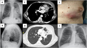 (A) PA (posteroanterior) and (B) L (lateral) Chest X-ray. Heterogeneous opacification within the left upper lobe (LUL), accompanied by pseudonodular opacities in the left parahiliar region. Secondary signs of volume loss, including mild elevation of the left hemidiaphragm and anterior displacement of the left minor fissure. (C, D) CT chest scan showed a heterogeneous consolidation with air bronchogram in LUL, extending into the lingula and associated with volume loss. Absence of central or endobronchial mass. In the anterolateral arch of the 4th left rib, small lytic areas as well as focal cortical disruption were seen at multiple points. Diffuse increase of soft parts in the adjacent chest wall was associated, with marked thickening of the pectoral musculature (2.6cm thick) visualizes small hypodense collections inside it. Trabeculation of adjacent subcutaneous fat and slight skin thickening in ipsilateral pectoral region. The findings suggest a pneumonia in LUL with the extension by contiguity to the left pleura and chest wall (empyema necessitatis). (E) Picture of the left pectoral mass and an ampoule within purulent content. (F) 8 months follow-up PA Chest X-ray. Complete resolution of empyema necessitates with linear opacities in the LUL compatible with parenchymal scarring. Bilateral hyperinflation.
