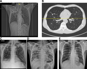 Representative radiographic and high-resolution CT images of patients with microbiologically confirmed pulmonary TB. (A) Extensive right upper lobe volume loss, fibrotic scarring, and tracheal deviation to the right—hallmarks of post-tuberculosis fibrotic lung damage, (B) Bilateral bronchiectasis with dilated bronchi, parenchymal scarring, (C) Cavitary lesions and right upper lobe fibrosis, (D) and (E) Severe fibrosis and bronchiectasis.