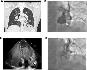 Imaging of the pulmonary arteriovenous malformation. An initial thoracic CT revealed (A) dilated and tortuous pulmonary arteries and veins that joined together in a nodule of 32mm in the left lower lung lobe consistent with a pulmonary arteriovenous malformation (gray arrow); this was also confirmed during pulmonary angiography (white arrow, B). A transthoracic contrast echocardiography with agitated saline was performed. After ten cardiac cycles, countless saline bubbles were observed traveling through the left inferior pulmonary vein (black arrow) into the left atrium (C) without a Valsalva maneuver suggestive of significant right-to-left shunt. It also showed dilated right ventricle, systolic flattening of the interventricular septum and increased tricuspid regurgitation velocity. The pulmonary arteriovenous malformation was treated via vascular plug closure (D).