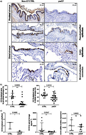 Lower expression of CC16 in lung explant tissues and in air–liquid interface (ALI) cultures of bronchial epithelial cells from people with cystic fibrosis (pwCF) at end-stage disease compared with tissues from non-CF controls (CTRL). (A) Representative images of CC16 immunostaining in the respiratory tract of CTRL and pwCF, (b) quantification of CC16-stained area in the proximal airways of 14 CTRL and 19 pwCF, and in the distal airways of 19 CTRL and 27 pwCF, (c) quantification in ALI-HBECs of CC16-positive cells per field (3 fields/culture, 3 CTRL and 4 pwCF), of CC16 protein release in the apical lavage (8 CTRL and 8 pwCF), and of CC16 mRNA expression normalised to the geometric mean of three housekeeping genes (7 CTRL and 10 pwCF). Mann–Whitney U test. Data are expressed as median±interquartile range.