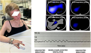Breathing pattern recording and images obtained by electrical impedance tomography during unassisted breathing and wheelchair-assisted ventilation. Regional lung ventilation and the difference between the inspiratory and expiratory phase are shown in blue and grey color, respectively.