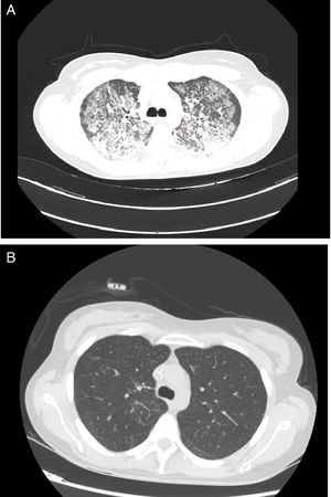 (A) High-resolution chest CT showing bilateral ground-glass opacities with a crazy-paving pattern before HSCT. (B) Complete radiological resolution 2 months after hematopoietic stem cell transplantation.