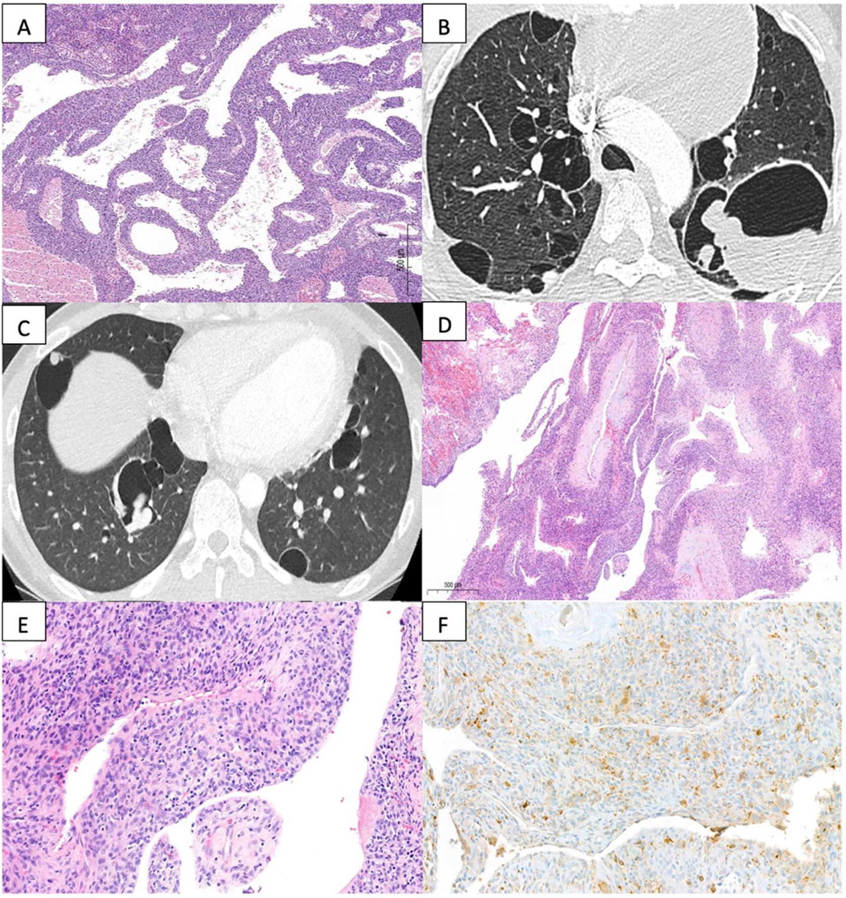 Pulmonary and Cutaneous Angiomatoid Fibrous Histiocytoma Archivos de Bronconeumología