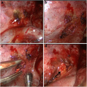 This figure shows intraoperative images in stages. The area indicated by the white arrow in (a) is the area where the lung parenchyma is adhered, and the foreign body is removed from underneath. (b and c) The folded wire piece of a metal dish sponge. (d) The vertebral body after the complete removal of the foreign body is shown with a black arrow.