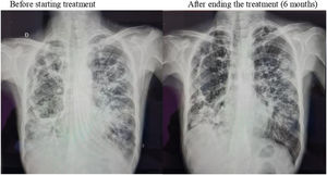 Chest X-ray film of the patient. (A) Before starting treatment. (B) After ending the treatment (6 months).