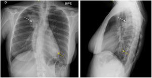 Posteroanterior and lateral chest radiograph with consolidation in the right upper lobe (white arrow) and left lower lobe (yellow arrow).