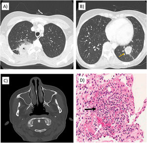 (A) Thoracic computed tomography (CT) with consolidation in the posterior segment of the right upper lobe with necrotic core (white arrow). (B) Thoracic CT with consolidation in the medial basal segment of the left lower lobe (yellow arrow). (C) CT of paranasal sinuses with complete occupation of both maxillary sinuses. (D) Histologic section of transbronchial biopsy in posterior segment of right upper lobe with presence of lung parenchyma with air spaces replaced by inflammatory cellularity of lymphohistiocytic predominance, granuloma (black arrow) and vascular inflammation with fibrinoid necrosis (white arrow).