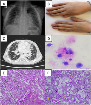 (A) Chest X-ray image showing diffuse bilateral reticular opacity increase. (B) Clubbing image of sJIA-LD patient. (C) High resolution computed tomography image showing diffuse interlobular septal thickening, fibroelectatic retractions, honeycomb pattern, peribronchovascular thickening. (D) Bronchoalveolar lavage cytology image showing lipid-laden macrophages with PAS staining. (E) Lung biopsy pathology image showing cholesterol clefts (black arrows), interstitial fibrosis, and chronic inflammation (yellow stars) in lung parenchyma (hematoxylin and eosin stain, 40×). (F) Lung biopsy pathology image showing cholesterol clefts (black arrows), interstitial fibrosis, and chronic inflammation (yellow stars), and multinucleated giant cells (green arrow) with higher magnification (hematoxylin and eosin stain, 100×).