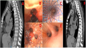 (A) Chest computer tomography (CT): Tracheoesophageal fistula due to displacement of esophageal metallic prosthesis. (B) Bronchoscopy: Direct view of a large tracheoesophageal fistula extending from the trachea to the entrance of the left main bronchus. (C) Rigid Bronchoscopy: Placement of a self-expanding metallic tracheal prosthesis. (D) Rigid bronchoscopy: Persistence of the fistula despite the placement of the tracheal prosthesis. The esophageal prosthesis, visible on the left side, is decided to be displaced cranially. (E) Rigid bronchoscopy: Direct view of the intact left bronchial system. (F) Chest CT: Coronal visualization of both prostheses overlapped, forming an esophagotracheal artificial wall and sealing the fistula.
