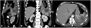 Thoracoabdominal sagittal (A), coronal (B), axial (C) CT; massive hemothorax (*) in the left pleural cavity, contour irregularity on the diaphragm surface and the appearance of diaphragm hematoma (H) are observed. Additionally, pancreas mass (black arrow) and adjacent spleen (S) metastasis (white arrow) are seen.