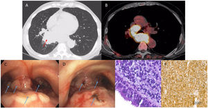 Mass on axial view on pulmonary windowing (A, red arrow) and mediastinal enlarged lymph node stations (7 and 4R) on axial view on Positron Emission Tomography CT-scan showing a high avidity for fluorodeoxyglucose-F18 tracer (B, color). Endobronchial implants located at the distal pars membranacea of the trachea, main carina and main bronchi (C, blue arrows) treated by laser Argon-Beamer (D, blue arrows). Endobronchial samplings with solid growth neoplasm infiltrating the bronchial mucosa, made up of medium-sized cells, with moderately pleomorphic and hyperchromatic nuclei (E, hematoxylin–eosin staining 400×). Neoplastic cells express B-lineage marker CD20 (F). The diagnosis of B-cell lymphoma was also confirmed by molecular analysis.