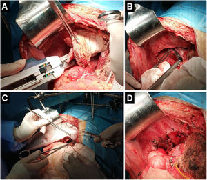 The images from the patient number 10 demonstrate intra-abdominal resection of the diaphragm and affected lung during the same session with right hepatectomy (A), transdiaphragmatic excision of four metastatic pulmonary nodules (B), reconstruction of the diaphragmatic defect after resection with an 8cm×5cm double mesh (C) and closure of the diaphragmatic defect after the procedure (D).