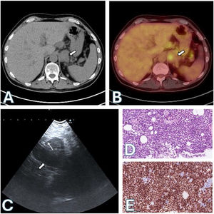 CT (A) and PET-CT (B) scans: left adrenal mass (thick arrows). (C) EUS-B image: transgastric needle aspiration (thin arrow) of the left adrenal mass (thick arrow). (D) Hematoxylin–eosin stain: atypical cells. (E) Positive dual SOX-10/Melan A stain.