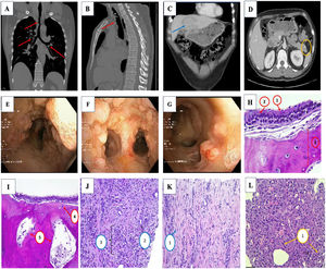 (A and B) Multiple foci of irregular mural thickening partially calcified in the trachea, in its two anterior thirds and with extension to the bronchial tree (red arrow). (C) Mass-like lesion in hepatic segment IV (blue arrow). (D) Lesion in the tail of the pancreas of approximately 11mm (yellow circle). (E–G) Polypoid lesions, petrosal, with scarce vascularization, without completely occluding the lumen of any bronchus, they respect the membranous the membranous side, more predominant in the trachea and main bronchi, which bronchi, decreasing in quantity until they are scarce at the level of segmental bronchi. (H) Respiratory type epithelium, formed by pseudostratified ciliated (1) and goblet cells (2) with presence of osteochondroblastic tissue in submucosa (3). (I) The bone component presents osteocytes (4), medullary cavities (5) and hematopoietic cellularity, surrounded by concentric lamellar bone matrix. (J and K) Proliferation of fibroblasts arranged in fascicles (1) encompassing some isolated bile duct (2). compatible with HIP. (L) Inflammatory infiltrate, with presence of lymphocytes, plasma cells, polymorphonuclear cells and eosinophils compatible with PNT (3).