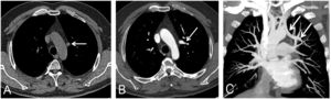 (A) Unenhanced axial thoracic CT image (mediastinal window) shows an abnormal structure adjacent to the aortic arch (white arrow). (B) Contrast-enhanced axial CT image (mediastinal window) at a lower level shows the left upper pulmonary vein entering the mediastinum (white arrow). (C) Contrast-enhanced coronal CT maximum intensity projection image shows the left upper pulmonary vein entering the mediastinum (arrows) and connecting with the left innominate vein (asterisk).