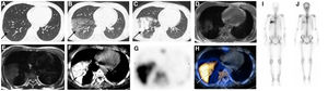 (A) Chest CT scan in the lung window. Patchy areas of ground-glass opacity in the lower leaf of right lung (arrow). (B) Half a month later, chest CT scan in the lung window showed diffuse and patchy areas of consolidation (arrow). (C) The density was significantly increased after anti-infective treatment for a period of time (arrows). (D and E) The magnetic resonance: showed uneven equal T1 and equal T2 signals. (F–H) SPECT/CT: the bone scintigraphy imaging demonstrated increased radioactive isotope uptake on the right lung, and subcutaneous soft tissue layer of the extremities. (J) Bone scintigraphy showed a significant decrease in radiation uptake in right lung lesions after treatment with sodium thiosulfate.