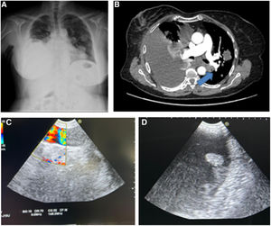 (A) Postero-lateral chest X-ray showing right pleural effusion along with contralateral nodular images. (B) Axial CT scan of the chest demonstrating pleural effusion along with an adenopathy cluster infiltrating the inferior pulmonary vein (arrow) and contralateral nodule. (C) Doppler ultrasound image at the level of the pulmonary vein showing an endoluminal vascular lesion with Doppler signal around it. (D) Ultrasound image revealing an implant at the level of the left cardiac cavity.