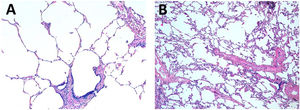 Histopathological findings. (A) Normal lung biopsy performed after reperfusion following extended 10°C preservation. (B) Mild interstitial infiltrate constituted by lymphocytes in a case with standard preservation on ice.