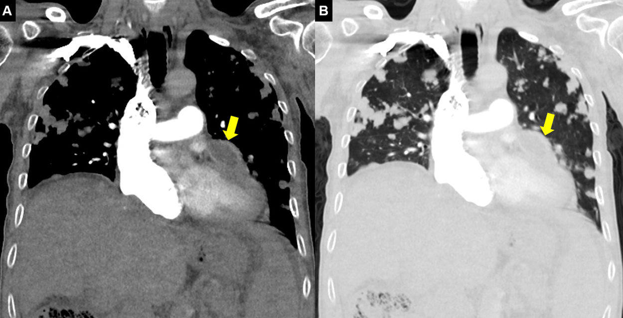 Diffuse Lung And Cardiac Involvement In Alveolar Echinococcus Archivos De Bronconeumología 