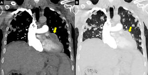 Contrast-enhanced thorax CT coronal sections (A, B) show a central hypodense, relatively thick-walled lesion (arrow) adjacent to the left ventricle and diffuse metastatic nodules in bilateral lungs.