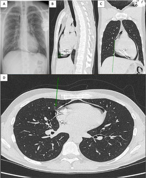Posterolateral chest radiography (A). Sagittal section chest computed tomography (B). Coronal and cross-section chest computed tomography (C and D) showing atrial and pleural perforation by pacemaker lead (arrows).
