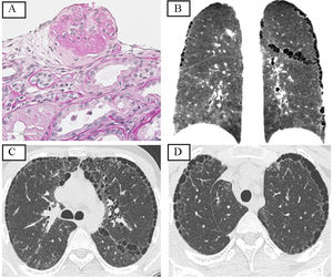 (A) Renal biopsy with crescents. (B–D) Thoracic computed tomography with multiple subpleural pulmonary cysts, small, peripheral and in cystic of small size, peripheral and in fissures arranged in a single row. Multiple small, low-density, centrolobulillary pulmonary nodules with mosaic pattern.