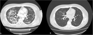 Patient 1. (A) CT scan shows subpleural parenchymal bands, ground-glass opacities and bilateral consolidations in both lung fields at 3 months after started apalutamide. (B) CT scan at 3 months after discontinuing apalutamide, showed a significant improvement with resolution of previously described pulmonary signs.